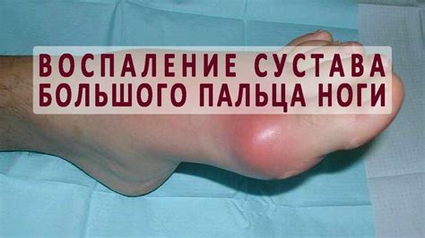 Резкая боль в суставе большого пальца ноги - причины и лечение